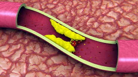 Blocked artery. https://www.info-on-high-blood-pressure.com/consequences-of-high-blood-pressure.html