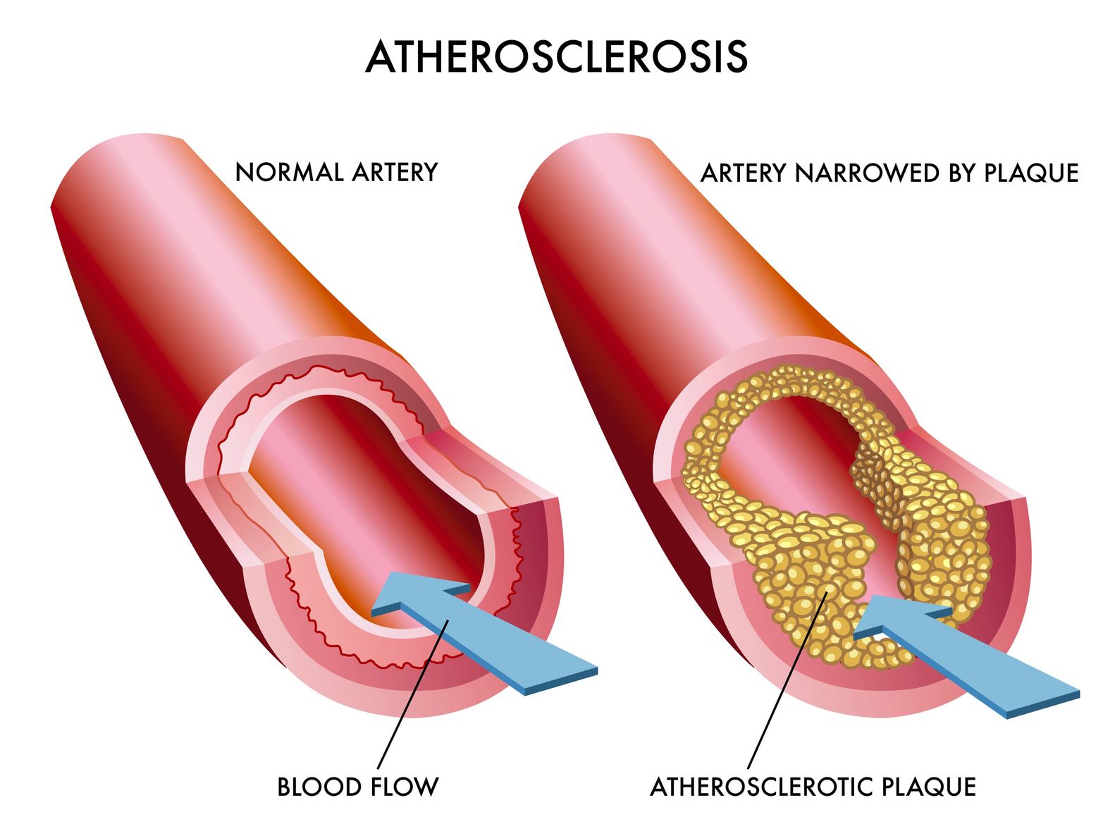 Blocked arteries.  https://www.info-on-high-blood-pressure.com/highbloodpressurehighcholesterol.html